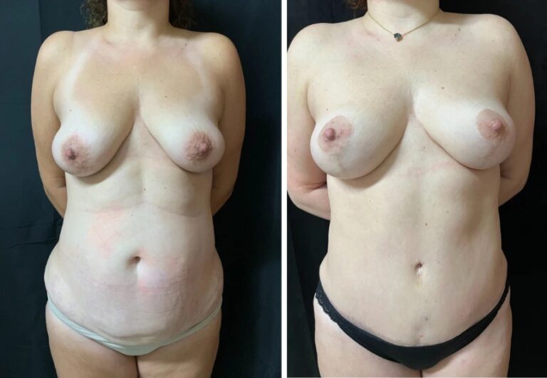 before and after breast reduction front view female patient case 28679