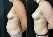 before and after breast reduction left side view female patient case 28679