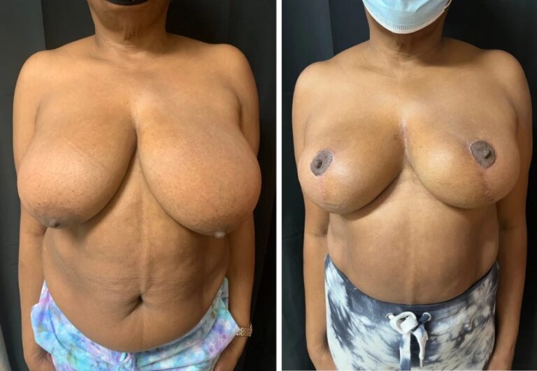 before and after breast reduction front view female patient case 28684