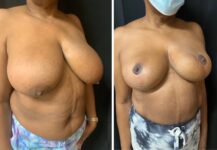 before and after breast reduction right angle view female patient case 28684