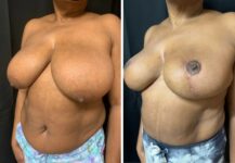 before and after breast reduction left angle view female patient case 28684