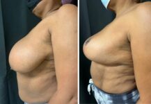 before and after breast reduction left side view female patient case 28684
