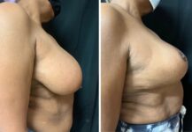 before and after breast reduction right side view female patient case 28684