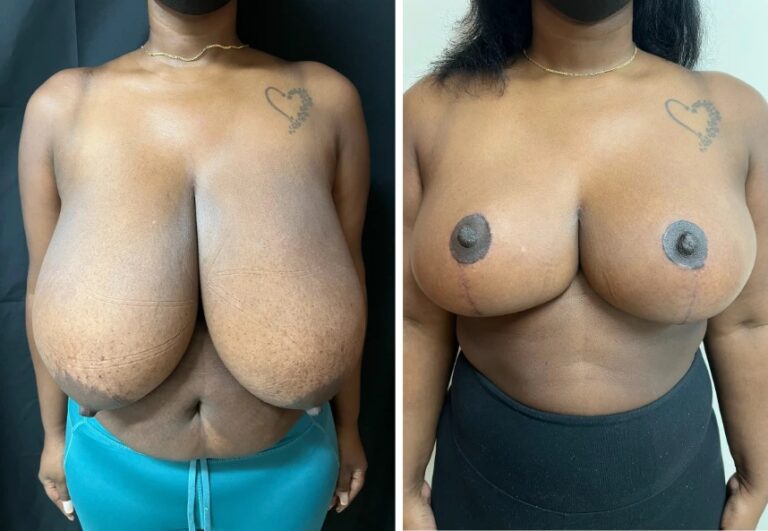before and after breast reduction front view female patient case 28690