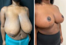 before and after breast reduction right angle view female patient case 28690