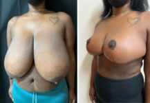 before and after breast reduction left angle view female patient case 28690