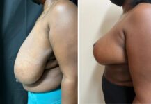 before and after breast reduction left side view female patient case 28690