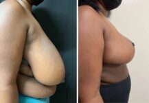 before and after breast reduction right side view female patient case 28690