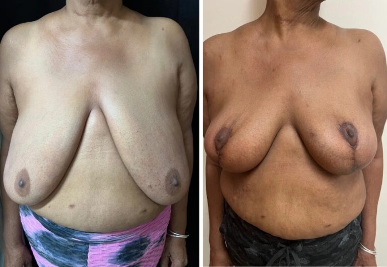 before and after breast reduction front view female patient case 28700