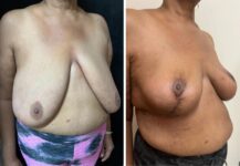 before and after breast reduction right angle view female patient case 28700