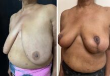 before and after breast reduction left angle view female patient case 28700