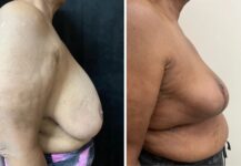 before and after breast reduction right side view female patient case 28700