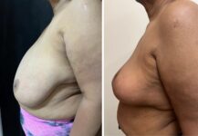 before and after breast reduction left side view female patient case 28700