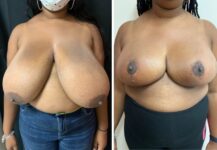 before and after breast reduction front view female patient case 28706