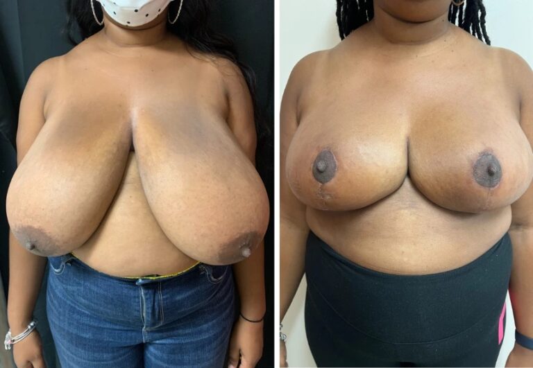 before and after breast reduction front view female patient case 28706