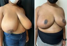 before and after breast reduction angle view female patient case 28706