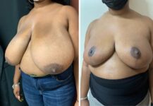 before and after breast reduction left angle view female patient case 28706