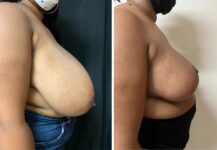 before and after breast reduction right side view female patient case 28706