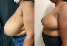 before and after breast reduction left side view female patient case 28706