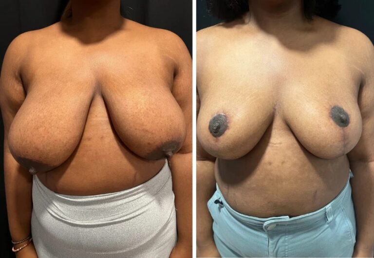 before and after breast reduction front view female patient case 28712