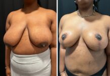 before and after breast reduction angle view female patient case 28712