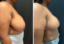 before and after breast reduction right side view female patient case 28712