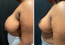 before and after breast reduction left side view female patient case 28712