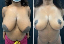 before and after breast reduction front view female patient case 28717
