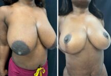 before and after breast reduction angle view female patient case 28717