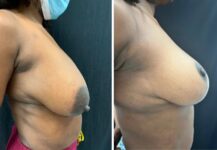 before and after breast reduction right side view female patient case 28717