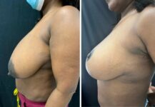 before and after breast reduction left side view female patient case 28717