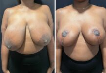 before and after breast reduction front view female patient case 28720