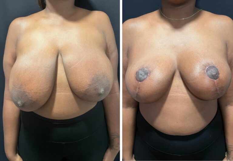 before and after breast reduction front view female patient case 28720