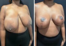 before and after breast reduction right angle view female patient case 28720