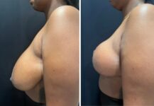 before and after breast reduction left side view female patient case 28720