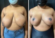 before and after breast reduction front view female patient case 28727