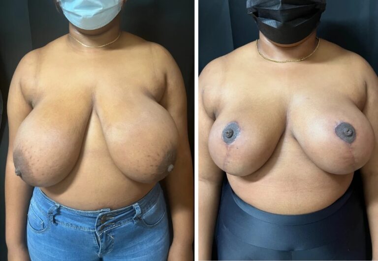 before and after breast reduction front view female patient case 28727