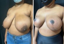 before and after breast reduction left angle view female patient case 28727