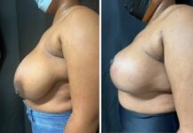 before and after breast reduction side view female patient case 28727