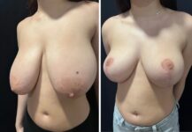 before and after breast reduction left angle view female patient case 28731