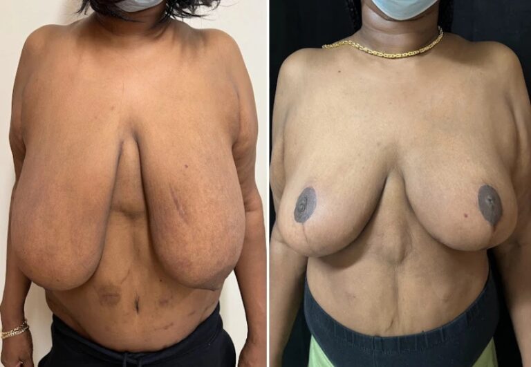 before and after breast reduction front view female patient case 28741