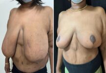 before and after breast reduction left angle view female patient case 28741