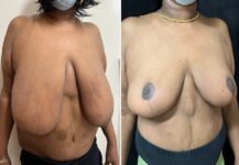 before and after breast reduction right angle view female patient case 28741