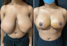 before and after breast reduction front view female patient case 28745