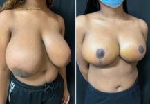 before and after breast reduction right angle view female patient case 28745