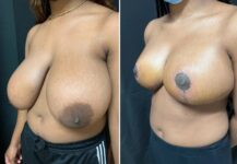 before and after breast reduction left angle view female patient case 28745