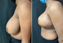 before and after breast reduction left angle view female patient case 28745