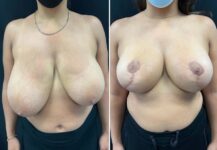 before and after breast reduction front view female patient case 28751