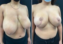before and after breast reduction right angle view female patient case 28751