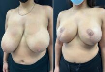 before and after breast reduction left angle view female patient case 28751